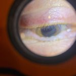 Eyelid margin affected by Demodex blepharitis viewed with Lumio device.