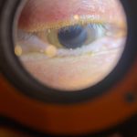 Close-up of eyelid showing signs of Demodex blepharitis under Lumio examination.