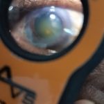 Dilated eye showing cataract formation under Lumio examination