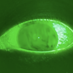 Fluorescent viewing of a human eye showing general region tear film breakup (darker regions) under fluorescein filter observation