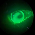 Fluorescein observation with a contact lens present leading to unusual lighting patterns