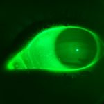 Horizontal fluorescent bands show how low the upper eye lid extends during blinking