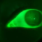 Fluorescent human eye showing illuminated green colours and darker regions of tear film instability