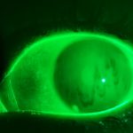 Close-up of an eye under fluorescent dye illumination, showing tear film stability used in dry eye disease diagnosis.