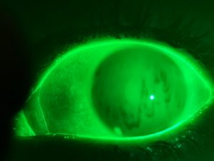 Close-up of an eye under fluorescent dye illumination, showing tear film stability used in dry eye disease diagnosis.
