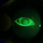 Patients' eye glow fluorescent green under revealing the state of the human tear film