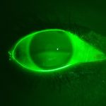 Fluorescent eye illuminated with fluorescein dye under blue light, highlighting tear film disruption due to partial blinking.