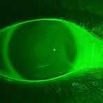 Injury (scratch) on lower cornea visible under fluorescent illumination