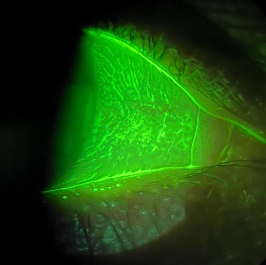 Image of the anterior segment of the eye using the tuned fluorescein filter from Aston Vision Sciences
