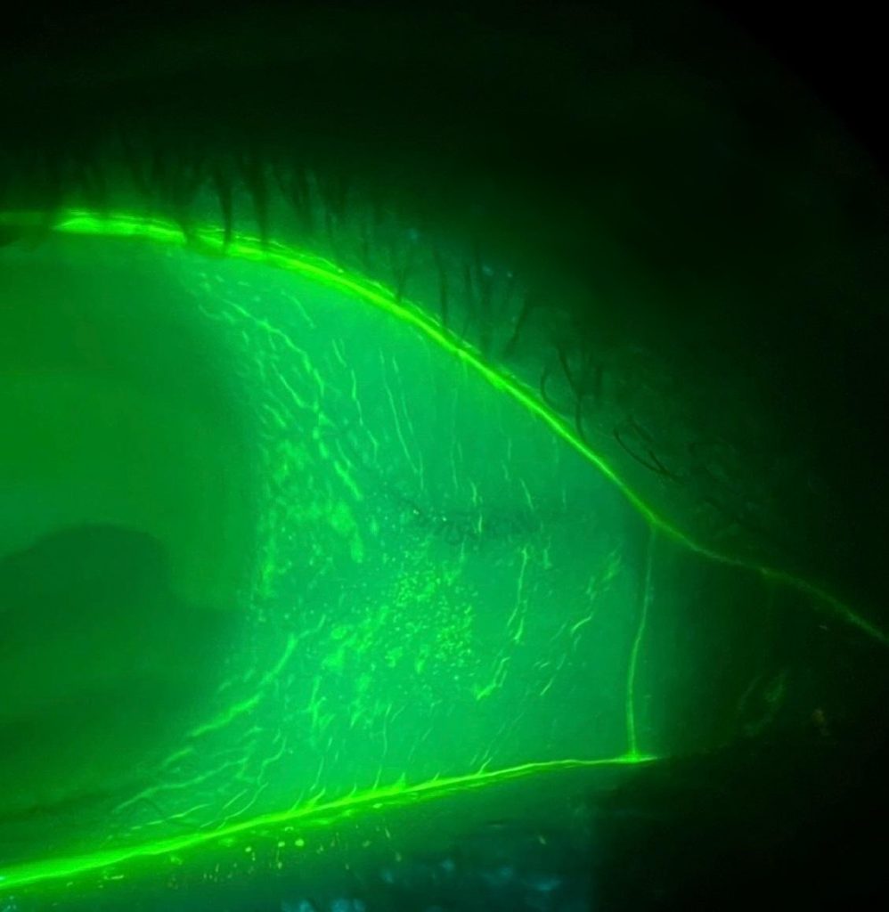 Image of the anterior segment of the eye under green illumination using a regular, non optimised Fluorescein Filter